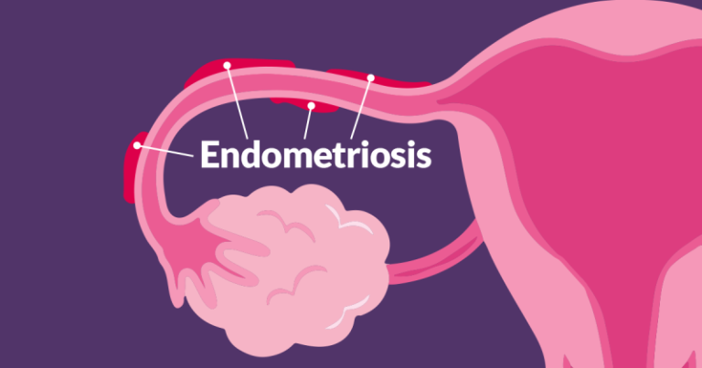 Endometriosis-800x420